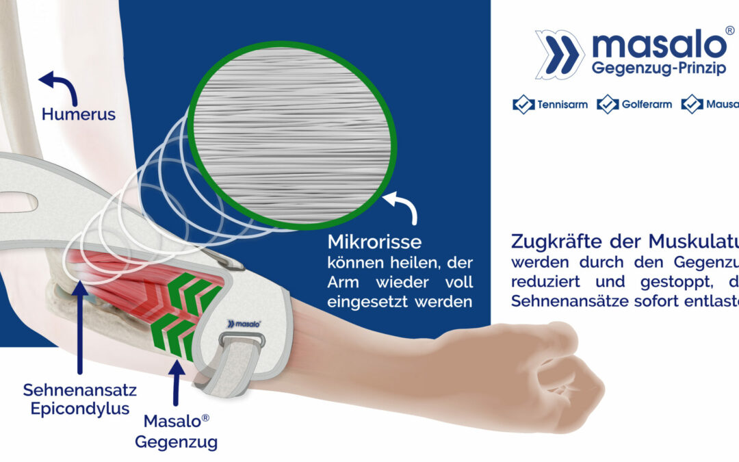 Einigartiges Wirkprinzip für sofortige Entlastung!